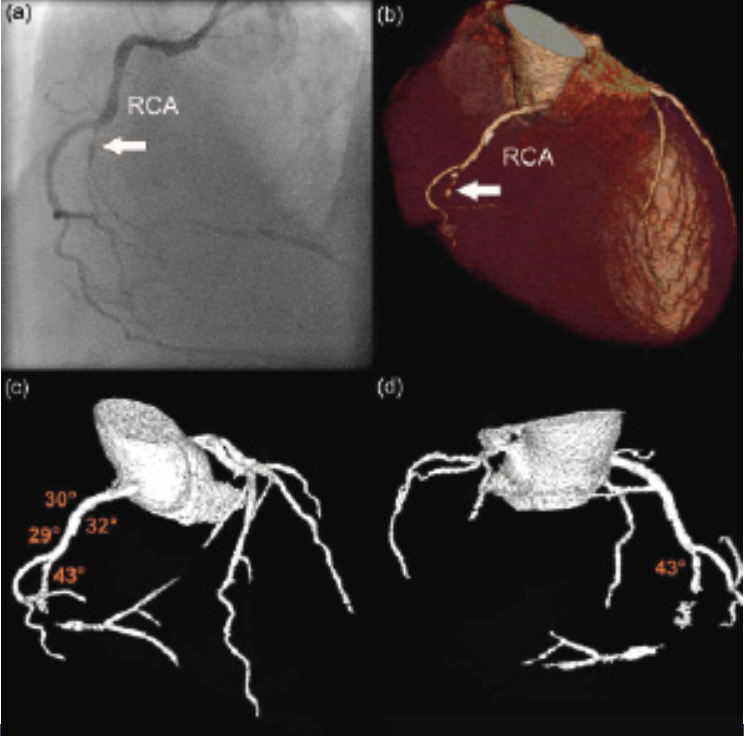 CiticMexico's tweet photo. #CTAfirst #CTO prep should include always #CTA 

@EuroInterventio  https://t.co/2QQfnW8tj9 

@drricalde @gpaymd @MauroEchavPinto @hect2701 @Heart_SCCT @PCRonline https://t.co/dVqm6NKlrD