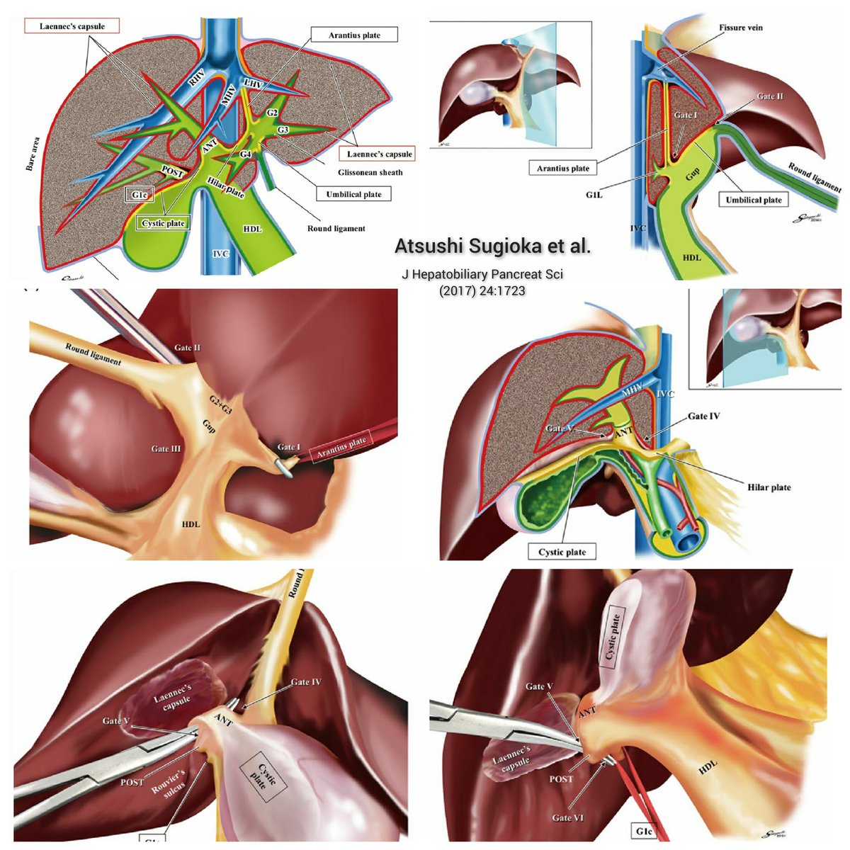 TeamSurgery247's tweet photo. Systematic extrahepatic Glissonean pedicle isolation for anatomical liver resection based on Laennec’s capsule: proposal of a novel comprehensive surgical anatomy of the liver @IHPBA @sminaev2015 @DrJonnys @hpb_so @HpbChl https://t.co/Af2IhpKtLF