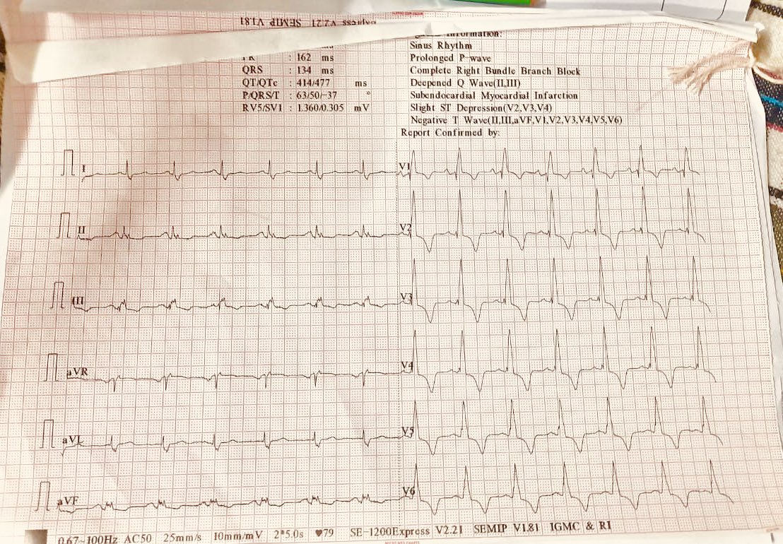 UlhasDr's tweet photo. RBBB and what else? (Dr Kavita)
#ECG @EPeeps_Bot https://t.co/Nl57VWrSl3