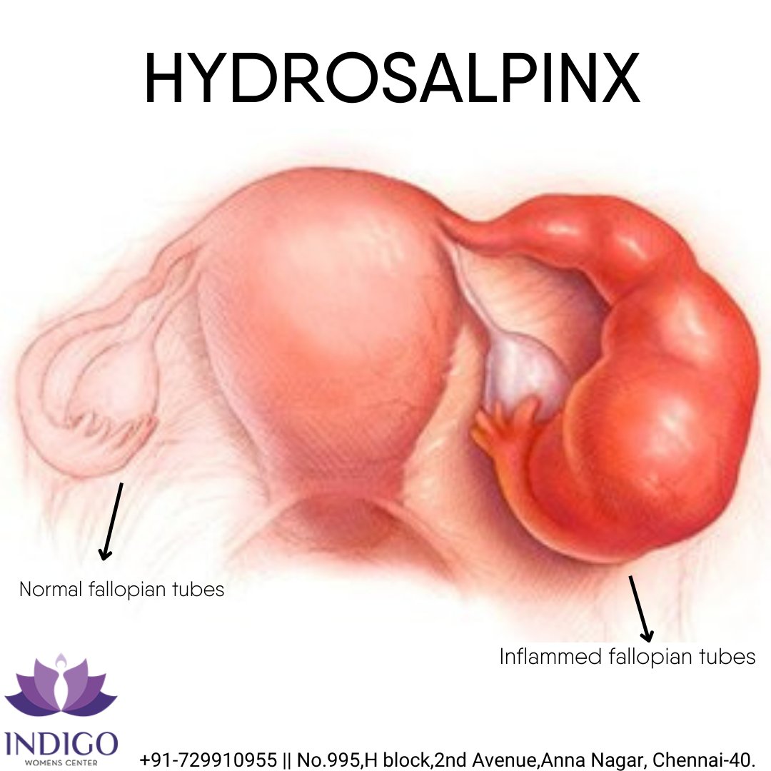 Indigowc's tweet photo. Hydrosalpinx refers to a fallopian tube that's blocked with a watery fluid.This condition is typically caused by a previous pelvic or sexually transmitted infection, a condition like endometriosis.
https://t.co/EvhKNBuQFu
#indigowomensfertility #fertilitycenter #hydrosalpinx https://t.co/OqC54m1il8
