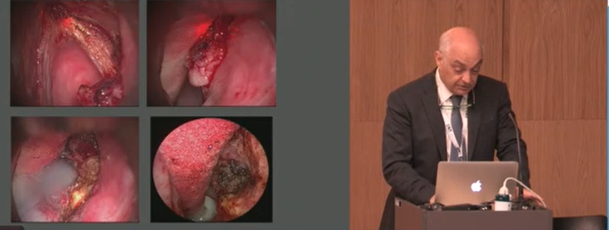 ENT_UK's tweet photo. Prof Dr Manuel Bernal Sprekelsen delivers his excellent session on transoral microsurgery of advanced tumours of the larynx... #SpringMeeting2022 https://t.co/8FlAhT5028