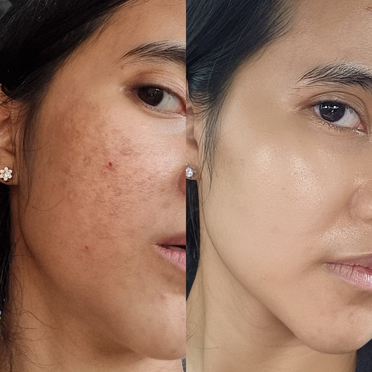 #ป้ายยา ใครที่หน้าเป็นสิว ผิวหมอง ลองกลูต้าคาเมโกะสารสกัดจากญี่ปุ่น สิวอักเสบ สิวผดหายเกลี้ยง รอยดำลดลงชัดมากก ลดสิวแถมหน้าใส ภายในสองสัปดาห์ #ไปตำ #ของดีราคาถูก พิกัด FB: Kameko เพจหลักบริษัท