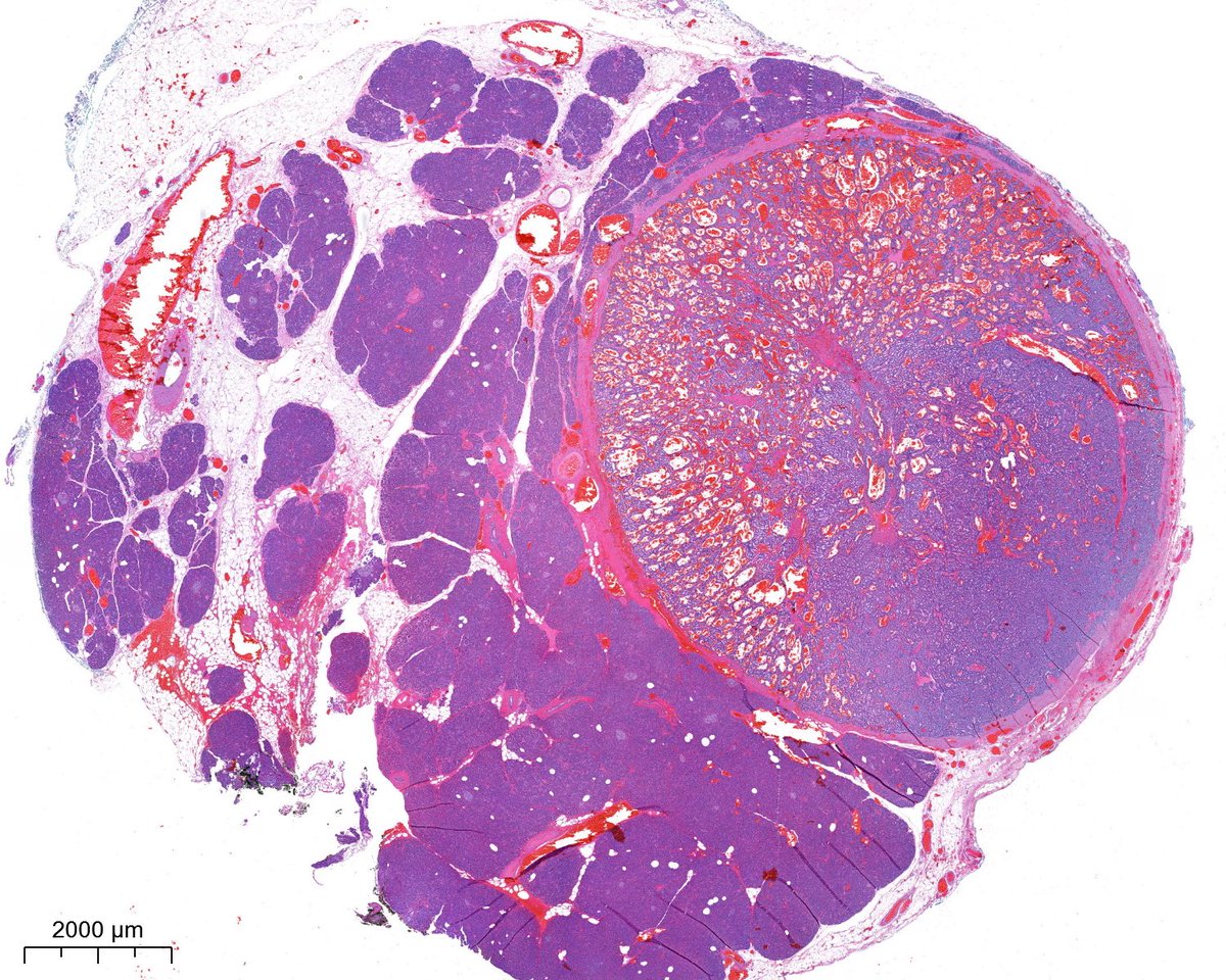 PoloniaAntonio's tweet image. F, 50s, I know it´s very easy...😃#GIpath @atman_ci @Teclis82 @DrGeeONE @A_Morini_MD @ariella8 @nusrat_xahra @miss_me1986 @gonzadetoro @SumantaDas_7 @kis_lorand @DraEosina @nucleololailo @joaquinnieves55 @padmapathology1 @DrNishatAfroz2 @Cristina_VargAP @DrBMcGinn @Histopatolomon