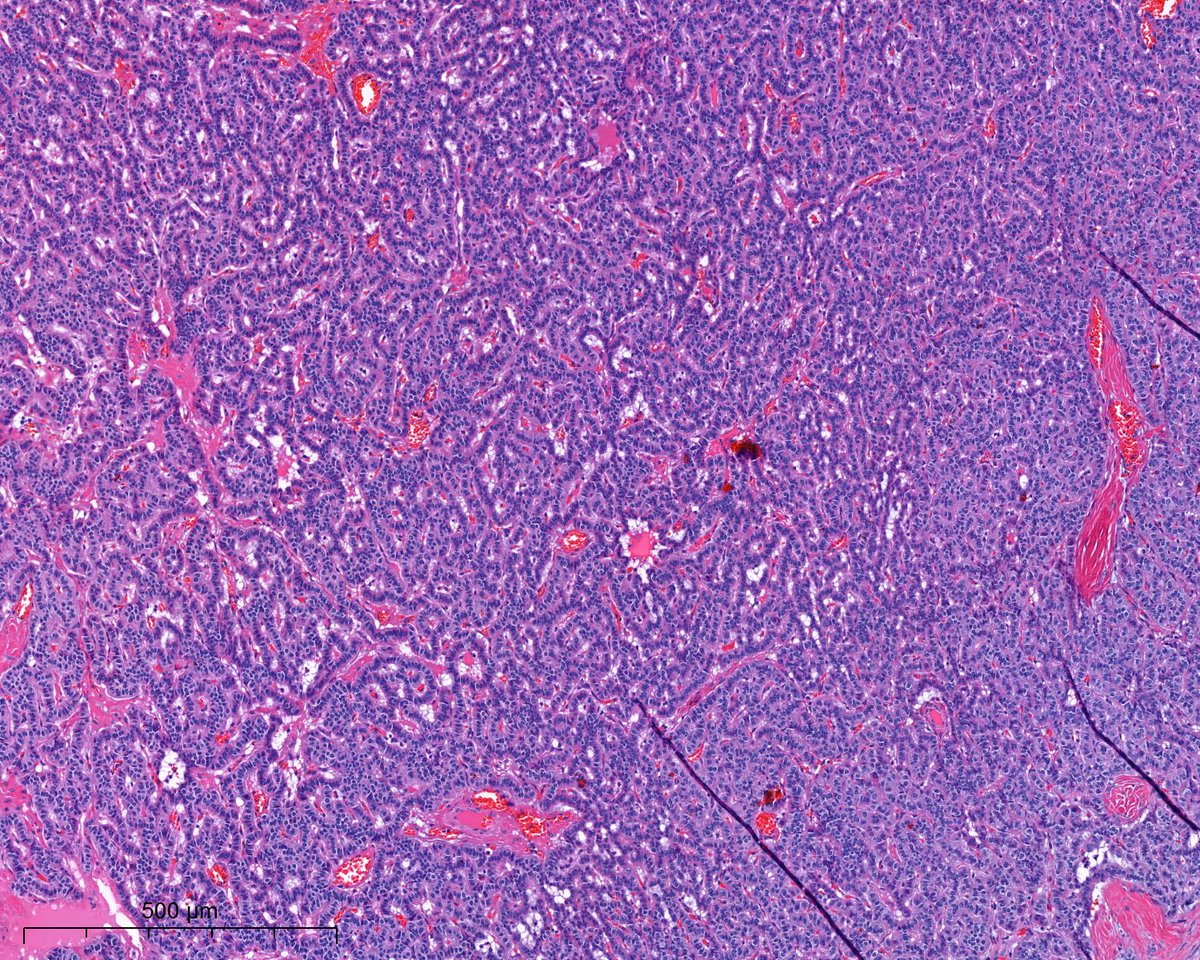 PoloniaAntonio's tweet image. F, 50s, I know it´s very easy...😃#GIpath @atman_ci @Teclis82 @DrGeeONE @A_Morini_MD @ariella8 @nusrat_xahra @miss_me1986 @gonzadetoro @SumantaDas_7 @kis_lorand @DraEosina @nucleololailo @joaquinnieves55 @padmapathology1 @DrNishatAfroz2 @Cristina_VargAP @DrBMcGinn @Histopatolomon