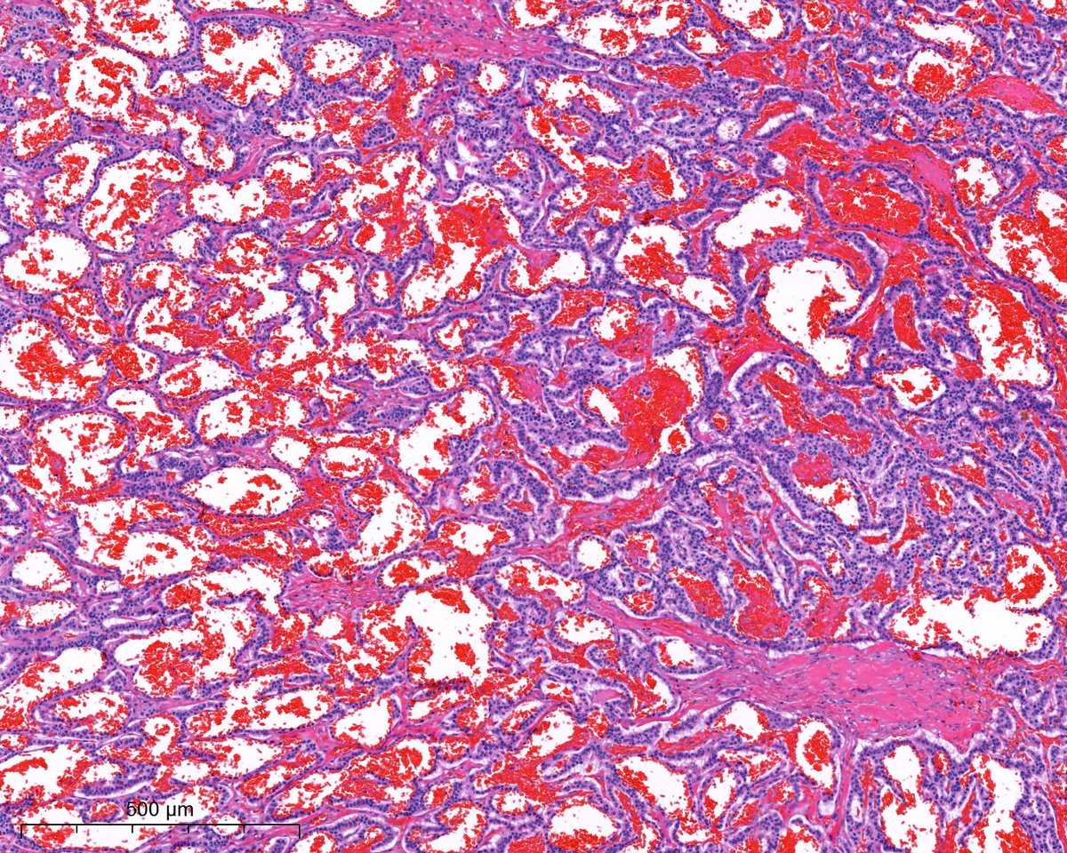 PoloniaAntonio's tweet image. F, 50s, I know it´s very easy...😃#GIpath @atman_ci @Teclis82 @DrGeeONE @A_Morini_MD @ariella8 @nusrat_xahra @miss_me1986 @gonzadetoro @SumantaDas_7 @kis_lorand @DraEosina @nucleololailo @joaquinnieves55 @padmapathology1 @DrNishatAfroz2 @Cristina_VargAP @DrBMcGinn @Histopatolomon