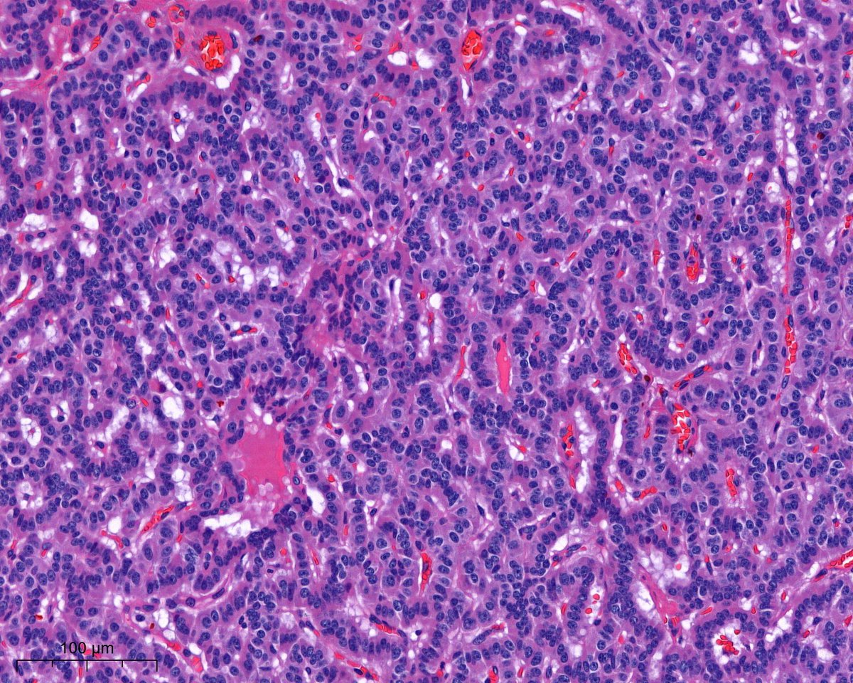 PoloniaAntonio's tweet image. F, 50s, I know it´s very easy...😃#GIpath @atman_ci @Teclis82 @DrGeeONE @A_Morini_MD @ariella8 @nusrat_xahra @miss_me1986 @gonzadetoro @SumantaDas_7 @kis_lorand @DraEosina @nucleololailo @joaquinnieves55 @padmapathology1 @DrNishatAfroz2 @Cristina_VargAP @DrBMcGinn @Histopatolomon