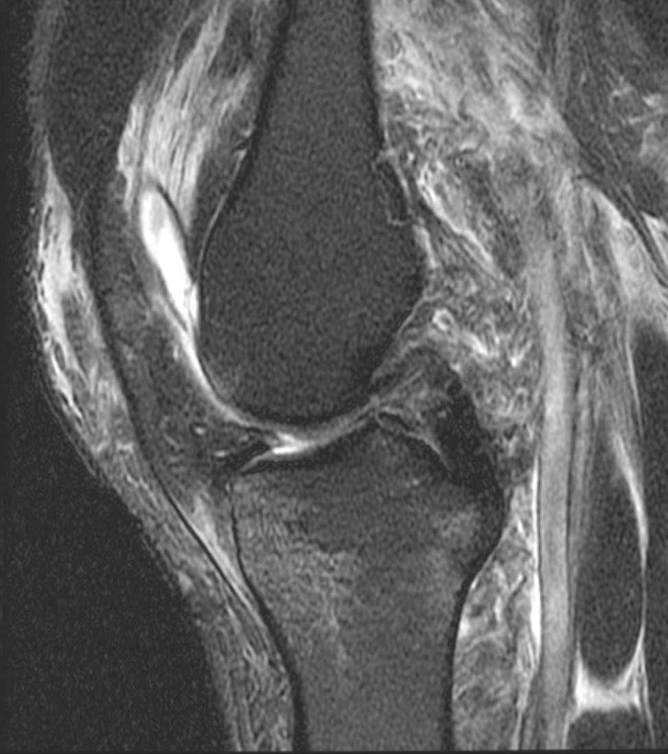 VolkerMusahl's tweet photo. Our newest #knee research from #SwedishKneeRegistry #SKLR  on PCL injuries additional injury to: meniscus only 15%, but cartilage 40%! Watch for #arthritis ! @KSSTA @bálintzsidai @senorski @EleonorSvantes1 @DrSamuelsson @philippwinkler @UPMCSportsMed https://t.co/SyTYtBL39Q