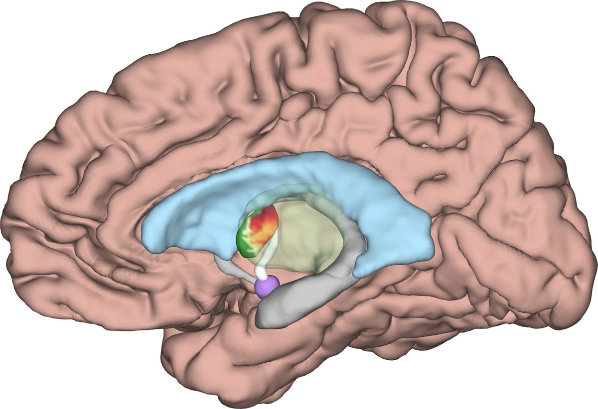 Excited to share the results of our <a href="/TheJNS/">Journal of Neurosurgery</a> paper, a meta-analysis of 7 studies and 162 patients showing that accurate targeting of ANT within subregions adjacent to the MTT improves DBS outcomes in epilepsy!
thejns.org/view/journals/…
