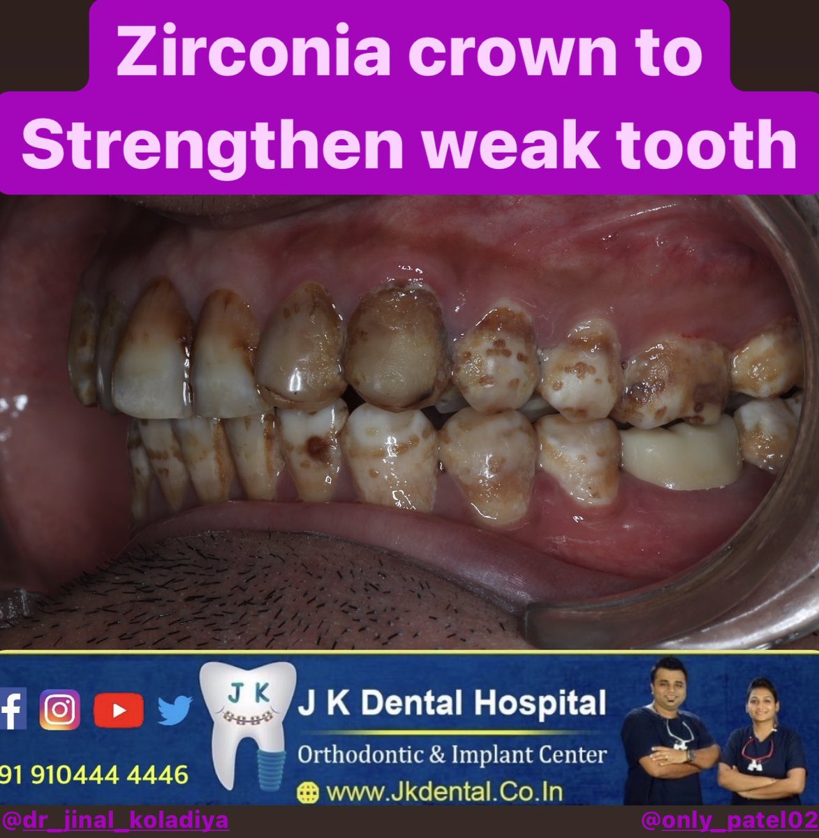 JKDENTALORTHO's tweet image. Zirconia crown placement was done at @JKDENTALORTHO , Ahmedabad.
This will strengthen the weak tooth structure and will look more aesthetic.

Visit us for your one step dental solution .
#dentist #orthodontist #covid #vaccine #braces #aligner #zirconia #trending #TrendingNow