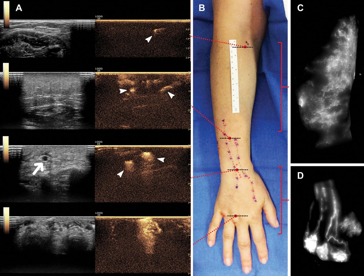 radiology_rsna's tweet photo. Contrast-enhanced US can help identify lymphatic vessels in late-stage lymphedema after breast cancer treatment, including cases where fluorescent lymphography fails. @MayoRadiology @SamJangMD https://t.co/RmAkY4IblO https://t.co/o7PDnGC9Po