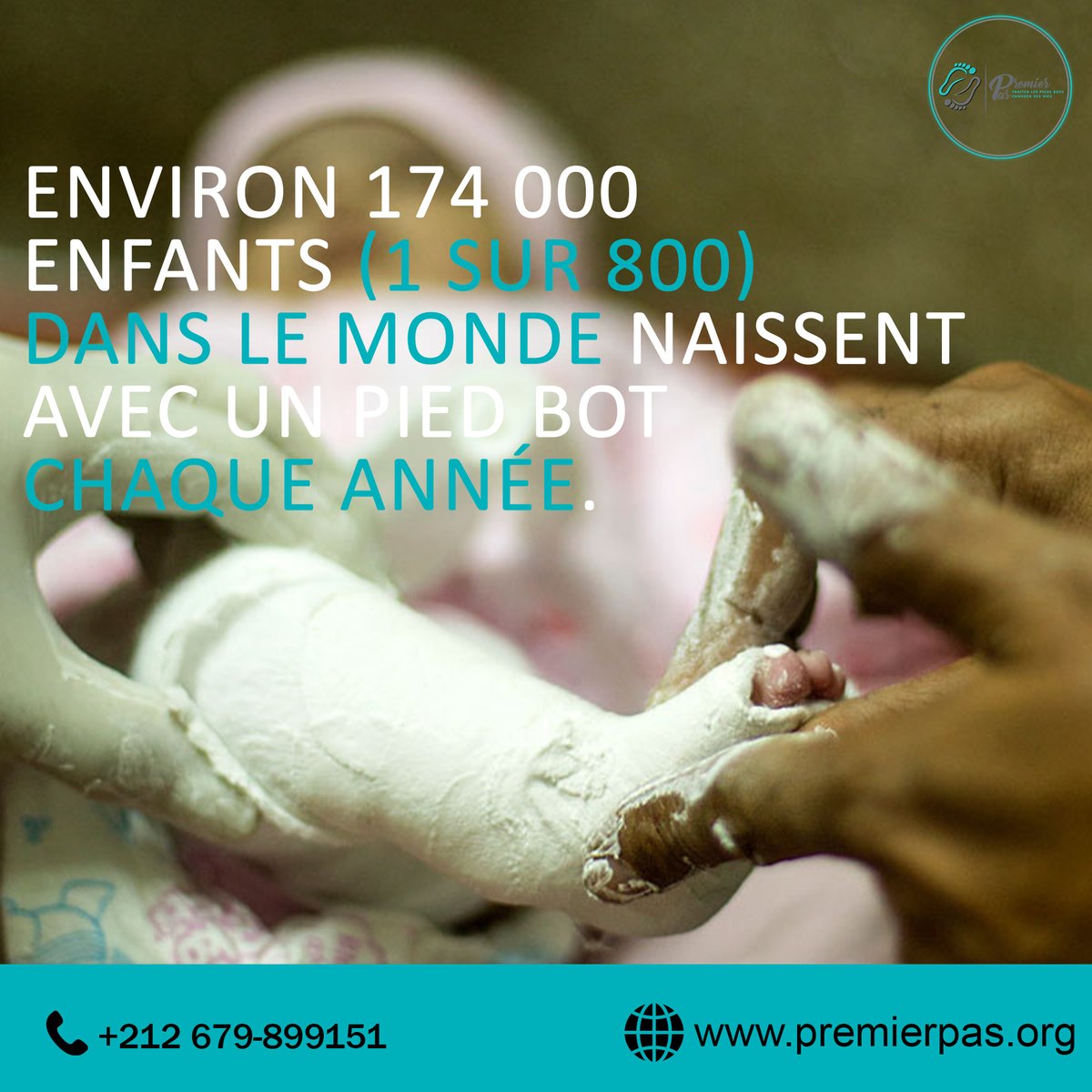 Environ 174 000 enfants (1 sur 800) dans le monde naissent avec un pied bot chaque année.