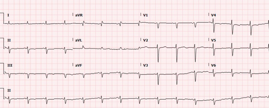#SCAICardioQuiz 63 y/o F presents to cardiology clinic for chest pain evaluation. She has PMH of HTN, DLD, GERD, and Hypothyroidism. Nonsmoker. No premature CAD in family. Non exertional epigastric pain with knot like sensation felt.