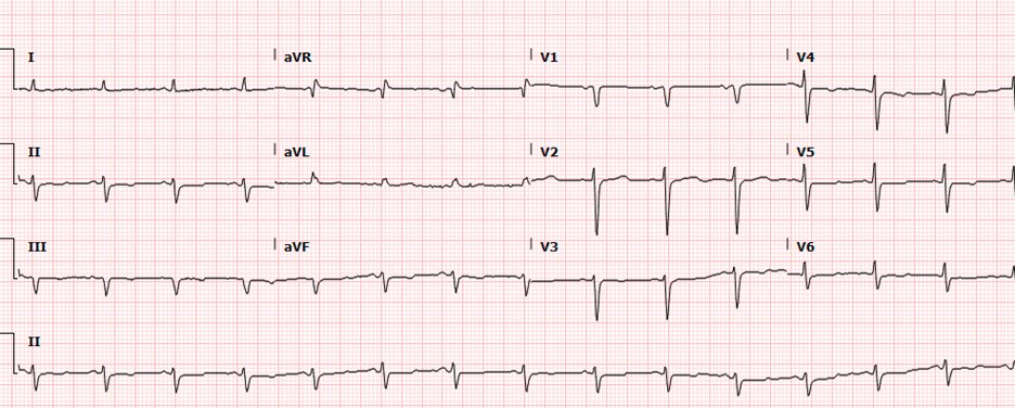 #SCAICardioQuiz 63 y/o F presents to cardiology clinic for chest pain evaluation. She has PMH of HTN, DLD, GERD, and Hypothyroidism. Nonsmoker. No premature CAD in family. Non exertional epigastric pain with knot like sensation felt.