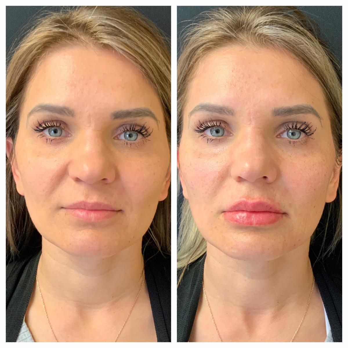 DrAdrianLo's tweet photo. #FillerFriday! 💋 Dermal fillers are a safe, natural way to achieve a refreshed look in as little as 30 minutes with essentially no downtime! Receive JUVÉDERM® and BOTOX® in the same appointment and get *DOUBLE ALLĒ POINTS* on JUVÉDERM®! ☎️ 215.829.6900 🌐 https://t.co/UrthFRX8IL