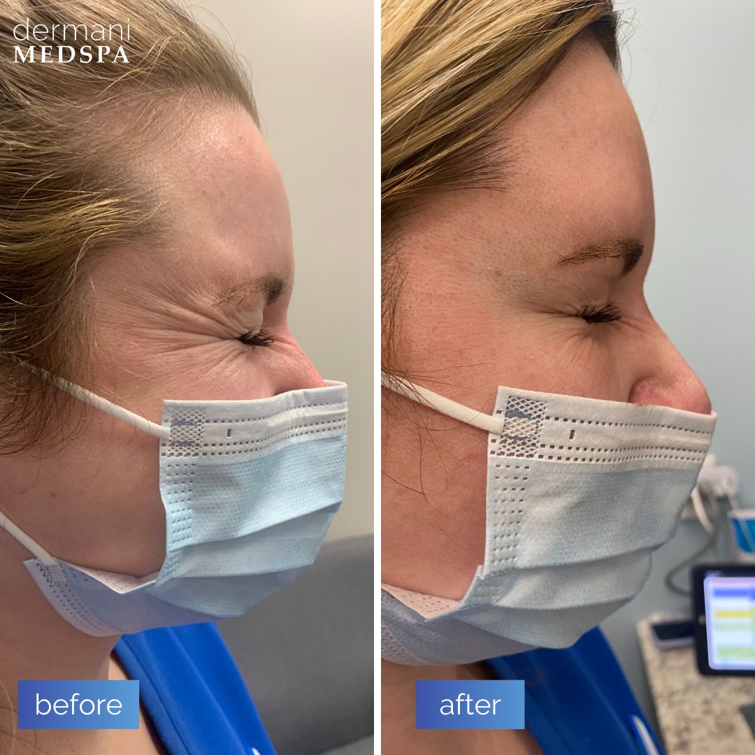 We are in 💙 with these #Botox® results!

What better place to get Botox® than the #1 provider in #Georgia?! Schedule your #freeconsultation to start your #BotoxCosmetic journey with us today!  💉

Schedule online at dermanimedspa.com/book-now! 💙