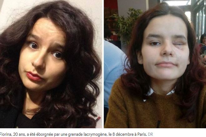 100drine_Juste's tweet photo. Pour #fiorina 20 ans eborgnée lors de la première manifestation de sa vie #plusjamaismacron #PlusJamaisPS tous ces visages mutilés sont le déshonneur de ce quinquennat de la honte . #electionpresidentielle2022 https://t.co/lhrRaNykdZ