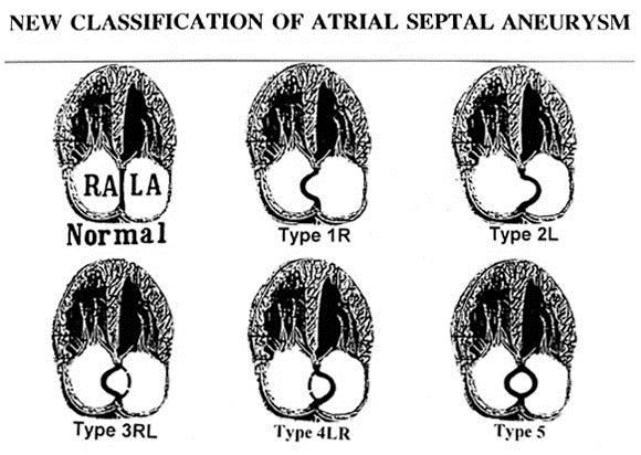 imJordan's tweet image. Atrial septal aneurysm classification #atrialseptalaneurysm #aneurysm #echofirst #echo #cardiotwitter #cardio #cardiology #atrialaneurysm