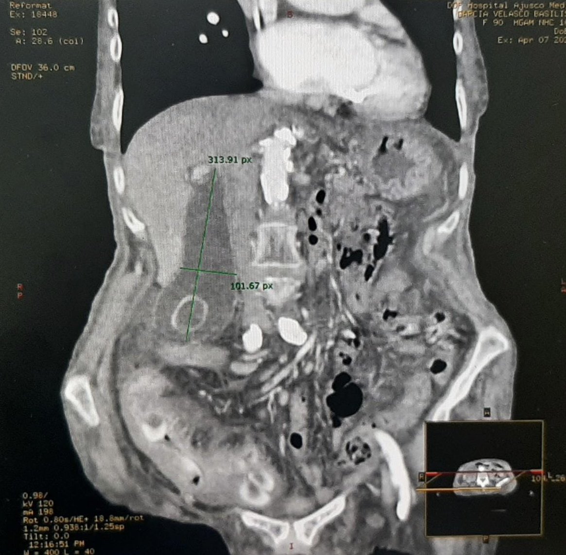 Palola0802's tweet photo. Una pequeña vesícula #SoMe4Surgery https://t.co/LTHRV2QehF