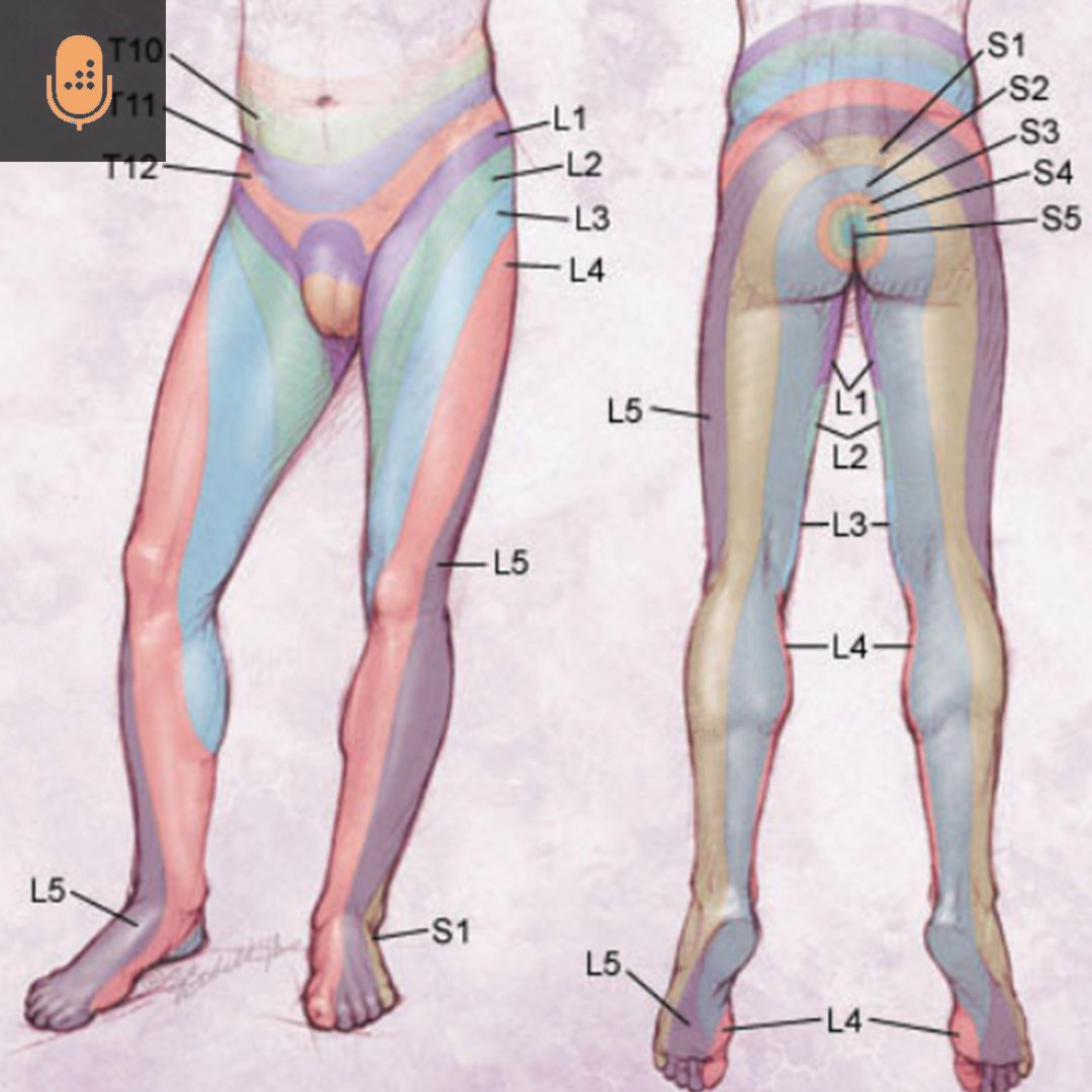 A Trendelenburg gait is caused by gluteus medius weakness. Gluteus medius is innervated by L5. Therefore a L5/S1 far lateral disc herniation could cause this condition.

Learn more about the Lower Extremity Spine &amp; Neuro Exam on our podcast. #orthotwitter orthobullets.tiny.us/362u9wyu