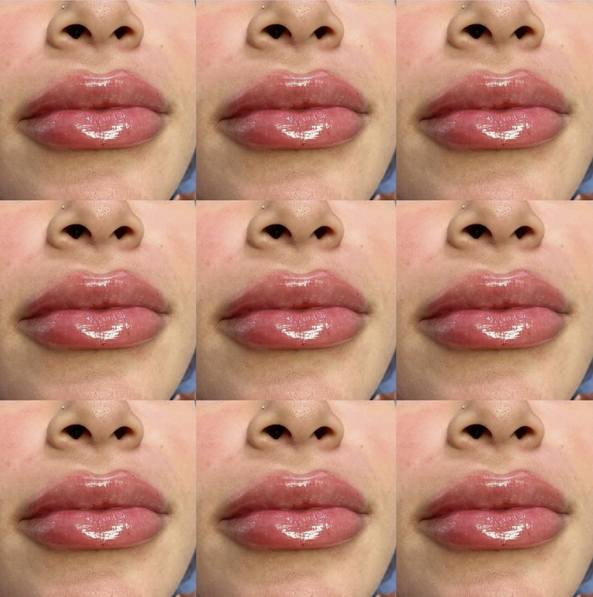 SplitRockAesIns's tweet photo. Lip filler on tap! Beautiful full lips, just what she ordered 💋 https://t.co/HBVFib99q1
