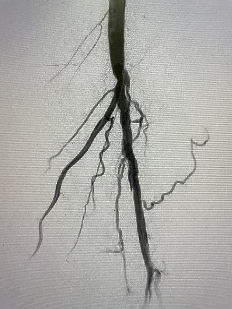 hufcm's tweet photo. Acute limb ischemia secondary to afib embolization to left pop.  Successful aspiration thrombectomy using 12F Lightning catheter.  @PenVascular https://t.co/u7gyJIwtxa
