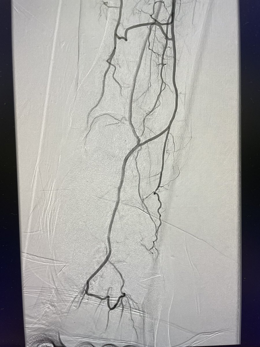 hufcm's tweet photo. Acute limb ischemia secondary to afib embolization to left pop.  Successful aspiration thrombectomy using 12F Lightning catheter.  @PenVascular https://t.co/u7gyJIwtxa