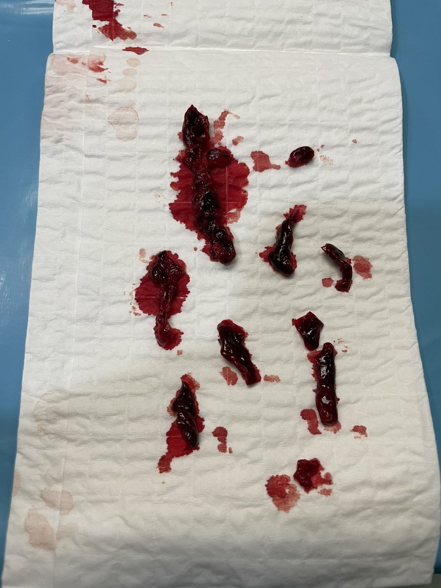 hufcm's tweet photo. Acute limb ischemia secondary to afib embolization to left pop.  Successful aspiration thrombectomy using 12F Lightning catheter.  @PenVascular https://t.co/u7gyJIwtxa