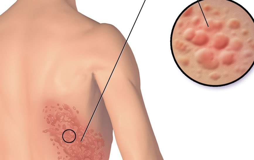 #رمضانيات 
حديثنا الليلة عن الحزام الناري أو ما يعرف بالهربس النطاقي :
✅الحزام الناري  ناتج عن فيروس...