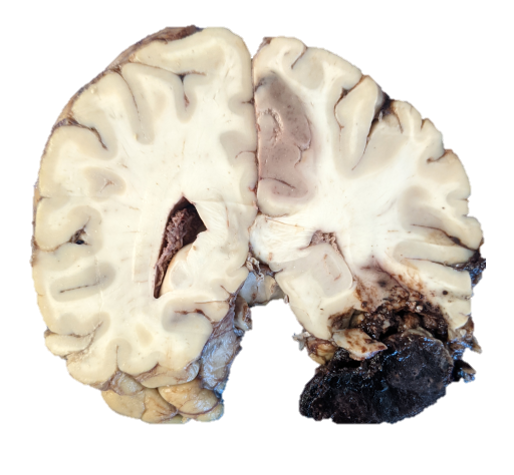 From the fellows conference: Cingulate infarct due to subfalcine herniation associated with a temporal lobe laceration after a fall.#neuropathology