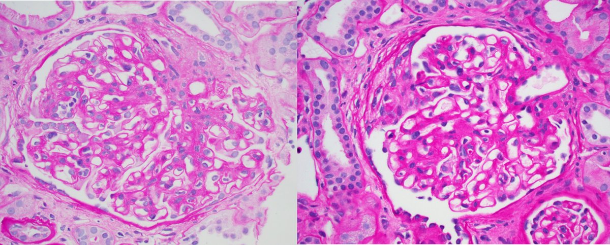 JZRenalPath's tweet image. Older pt w/DN, MGUS. Worsening renal function + proteinuria. Bx: mildly active endocapillary proliferative GN + segmental fibrous crescents. IF: C3 only. k/L (-). EM with fusiform intramembranous deposits: Dense deposit disease (monoclonal Ig associated). #renalpath #twitterpath