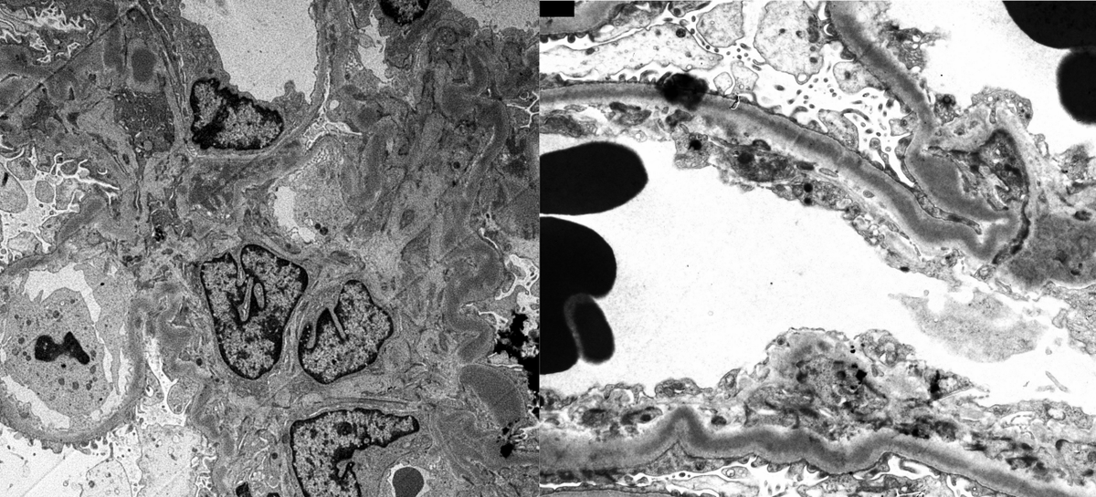 JZRenalPath's tweet image. Older pt w/DN, MGUS. Worsening renal function + proteinuria. Bx: mildly active endocapillary proliferative GN + segmental fibrous crescents. IF: C3 only. k/L (-). EM with fusiform intramembranous deposits: Dense deposit disease (monoclonal Ig associated). #renalpath #twitterpath