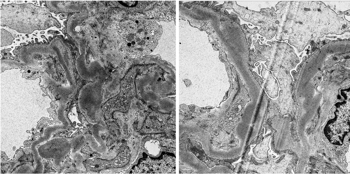 JZRenalPath's tweet image. Older pt w/DN, MGUS. Worsening renal function + proteinuria. Bx: mildly active endocapillary proliferative GN + segmental fibrous crescents. IF: C3 only. k/L (-). EM with fusiform intramembranous deposits: Dense deposit disease (monoclonal Ig associated). #renalpath #twitterpath
