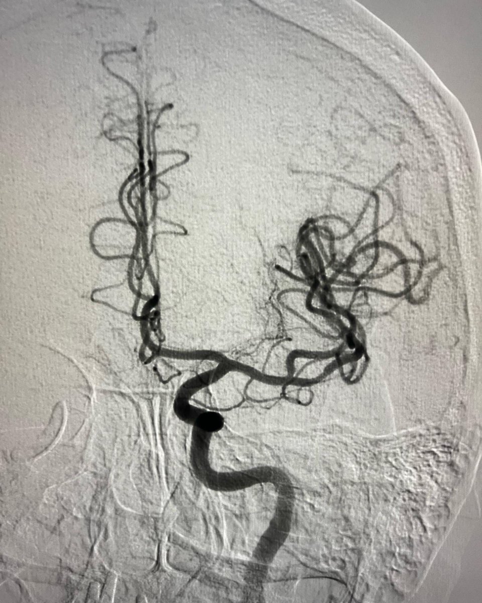 HaranhalliMD's tweet photo. Friday afternoon thrombectomy with Zoom 88/71 catheters by @imperative_care. Great trackability and atraumatic tips to get across a Type 3 arch, cervical ICA FMD and a tortuous intracranial ICA without traversing the clot #EVT #ADAPT #ZOOM https://t.co/fqwqoK7Tq2