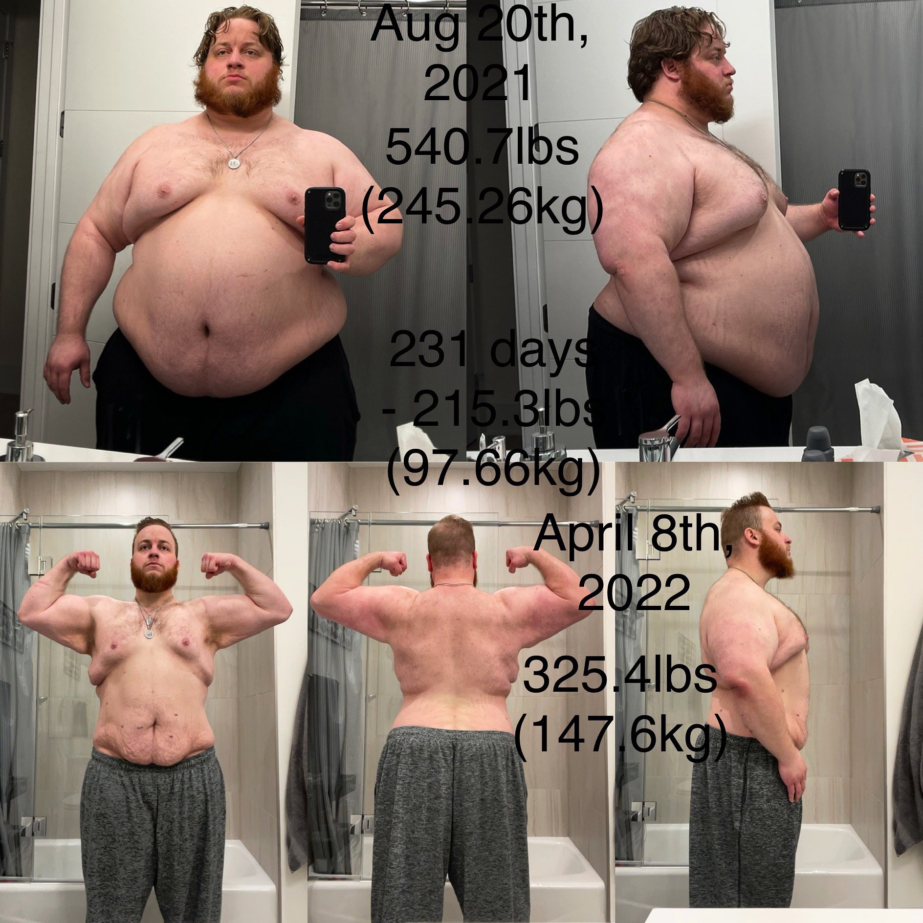 After Massive Weight Loss Case #534