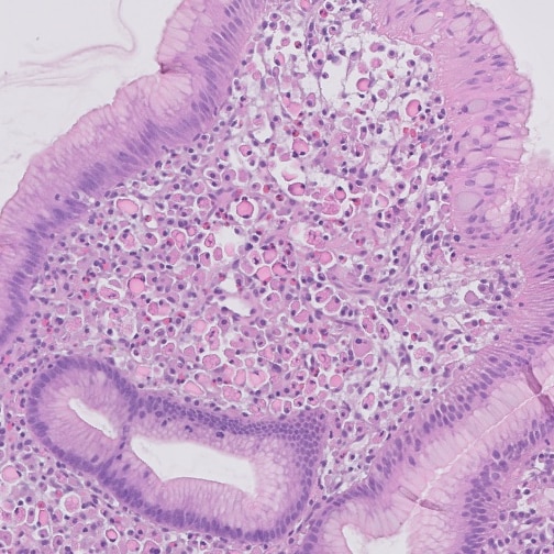 baking_md's tweet photo. Russell body gastritis, no H. pylori
#pathology #gipath https://t.co/bjFK3NEErh