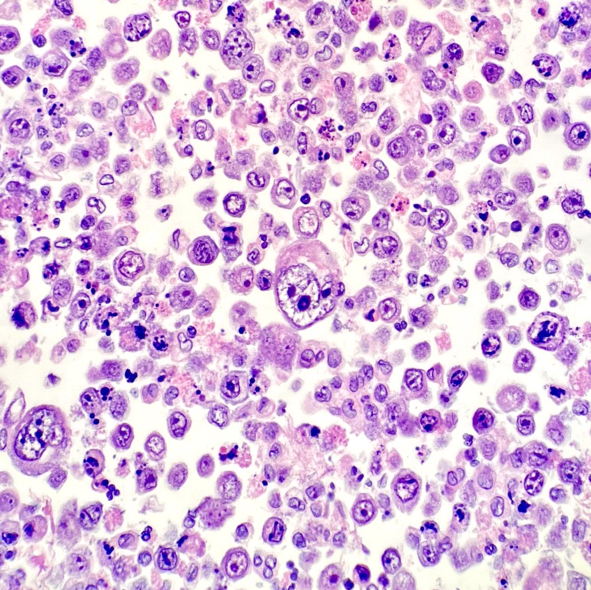 Gloria_SuraMD's tweet photo. Cell block preparation of a lung mass fine needle aspiration revealing poorly differentiated adenocarcinoma. #PathTwitter #CytoPath #Cytology #Pathology https://t.co/5eUOzFNZ8n