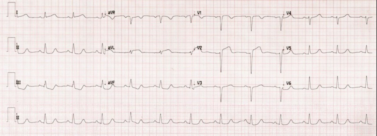 A woman in her 30s with sudden chest pain, nausea, and diaphoresis. Was her cardiology management appropriate? <a href="/PendellM/">Pendell Meyers</a> 

Can this ECG be misinterpreted?

hqmeded-ecg.blogspot.com/2022/04/a-woma…