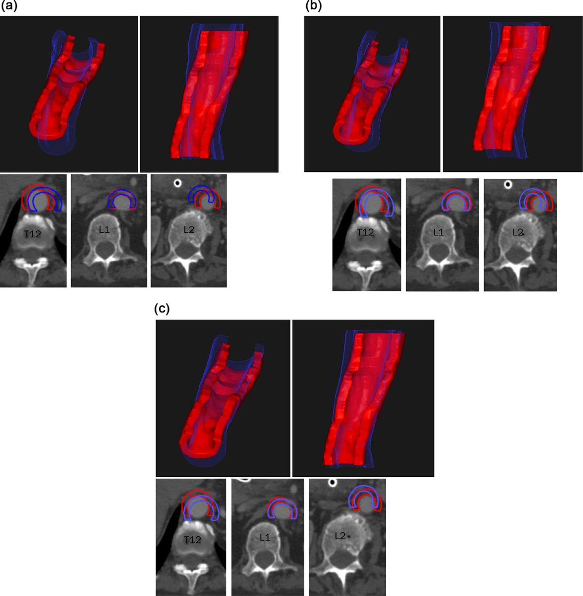 Dana Keilty (@danakeilty) on Twitter photo The aorta can move! <a href="/Jeff_D_Winter/">Jeff Winter</a> <a href="/SophieWeiweiGao/">Sophie Weiwei Gao</a> <a href="/teo_stanescu/">Teo Stanescu</a> <a href="/LawrenceYaacov/">Yaacov Lawrence Md</a> <a href="/ldawsonmd/">Laura Dawson</a>
Case report on challenging setup due to aorta mobility in a patient on the 25/1 celiac plexus #SBRT #ClinicalTrial. A consideration for spine/celiac plexus SBRT. advancesradonc.org/article/S2452-… The aorta can move! <a href="/Jeff_D_Winter/">Jeff Winter</a> <a href="/SophieWeiweiGao/">Sophie Weiwei Gao</a> <a href="/teo_stanescu/">Teo Stanescu</a> <a href="/LawrenceYaacov/">Yaacov Lawrence Md</a> <a href="/ldawsonmd/">Laura Dawson</a>
Case report on challenging setup due to aorta mobility in a patient on the 25/1 celiac plexus #SBRT #ClinicalTrial. A consideration for spine/celiac plexus SBRT. advancesradonc.org/article/S2452-…