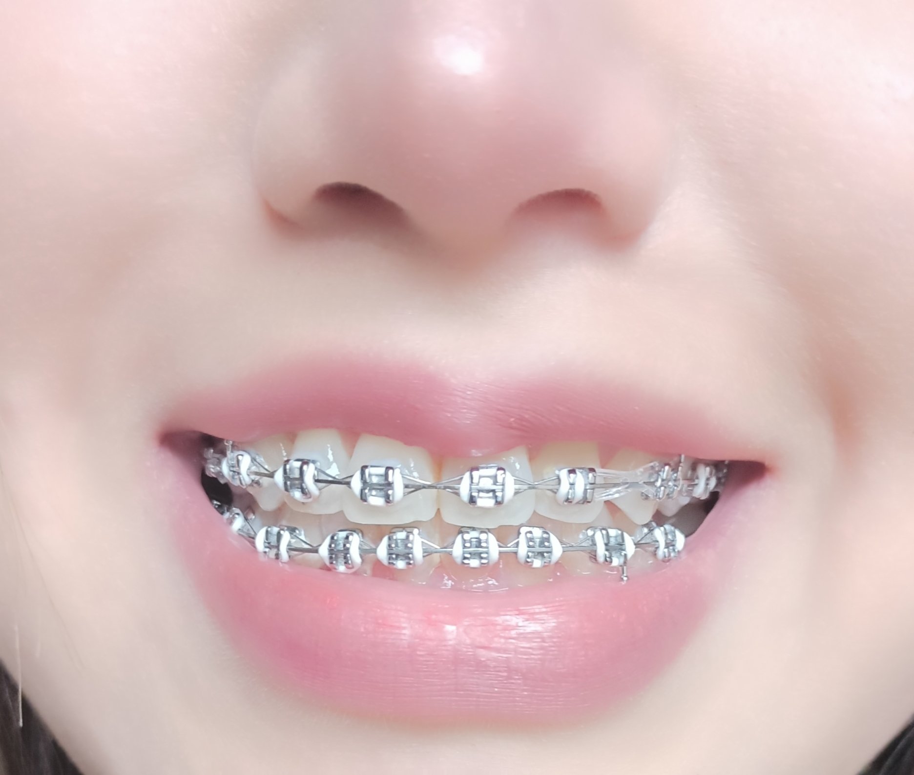 สีไหนสวย? สียางจัดฟัน เลือกจากได้เต็มที่ - Tăm Vip Á Đông สีไหนสวย? สียางจัดฟัน เลือกจากได้เต็มที่ - Tăm Vip Á Đông