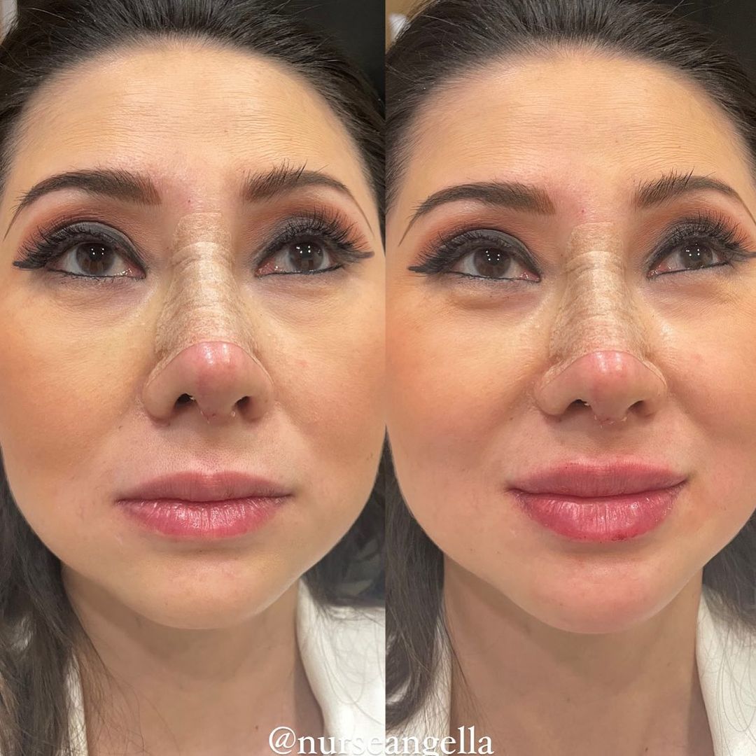 AlexWil44031986's tweet photo. 彼女の#prettytoprettierの旅のトップでした🍒でした。 *ドロップマイク*

#lipfiller #lipaugmentation #losangeles #westhollywood #beverlyhills #plasticsurgery #plasticsurgeon #aestheticnurse #nurseinjector #facialbalancing
#drdonaldt https://t.co/6O6HhkSMNK