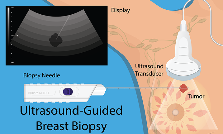 Janesthsurgres's tweet photo. A breast biopsy is a small piece of breast tissue that is removed and checked in a lab. This is done to see if cancer or other abnormal cells are present.
#surgery #breastbiopsy #biopsy #breasttissue #tissue #tissueculture #cancer #cancerresearch #abnormalcells #cells https://t.co/531fs7Ko4K