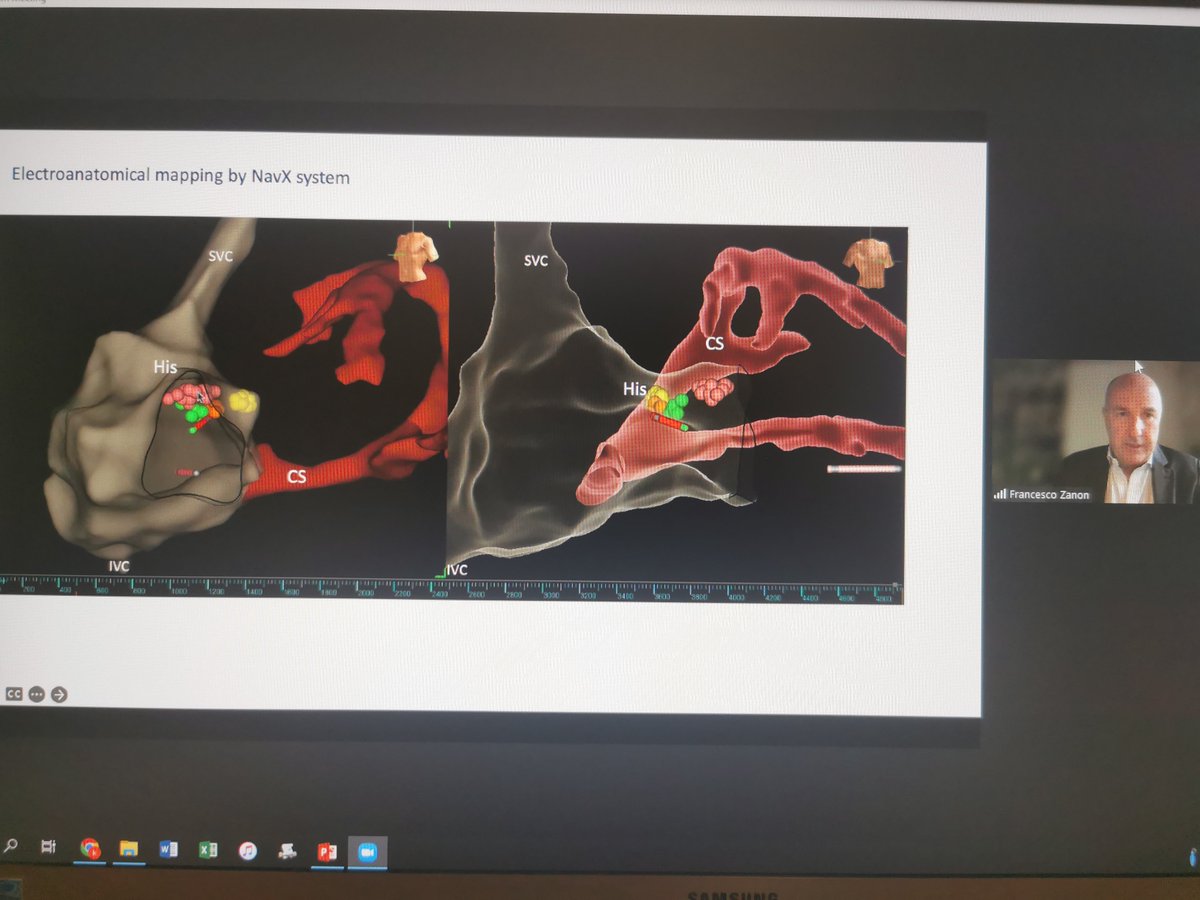 curilakarol (@curilakarol) on Twitter photo NavX during HPS pacing. Why not? <a href="/ZanonFrancesco/">Francesco Zanon</a> has substantial experiences with such approach and just present them during IASI2022. NavX during HPS pacing. Why not? <a href="/ZanonFrancesco/">Francesco Zanon</a> has substantial experiences with such approach and just present them during IASI2022.