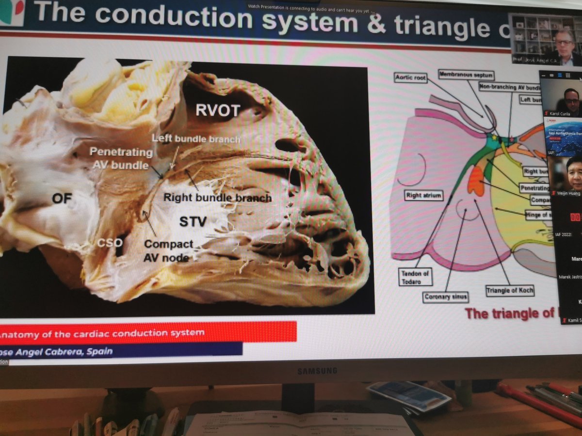 curilakarol (@curilakarol) on Twitter photo Just now <a href="/jacabreracardio/">Dr. José Ángel Cabrera</a> explains the anatomy of conductive system during <a href="/IasiArrhythmia/">IASI ARRHYTHMIA FORUM</a> Just now <a href="/jacabreracardio/">Dr. José Ángel Cabrera</a> explains the anatomy of conductive system during <a href="/IasiArrhythmia/">IASI ARRHYTHMIA FORUM</a>