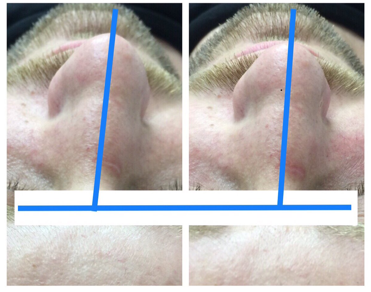 Десять минут работы руками и нос стал прямее, а левая ноздря задышала. 
В следующий раз продолжим..

#ПБД_до_после 
#Психобиодинамика