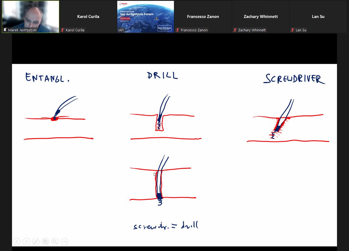 curilakarol (@curilakarol) on Twitter photo Screewdriver, drill, or entanglement during deep intra-septal lead deployment? <a href="/Marek_Jastrz_EP/">Marek Jastrzębski</a> can explain the best and presents during IASI2022 just now.
academic.oup.com/europace/artic… Screewdriver, drill, or entanglement during deep intra-septal lead deployment? <a href="/Marek_Jastrz_EP/">Marek Jastrzębski</a> can explain the best and presents during IASI2022 just now.
academic.oup.com/europace/artic…