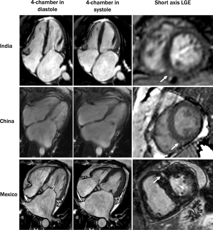 tiffchenMD's tweet photo. Global 🌏 #whyCMR 🧲 study on rheumatic MS in 🇮🇳🇨🇳🇲🇽 in @journalofCMR by star @PennCardiology #cvImaging fellow @mkvidula w/ #YuchiHan @VicFerrariMD @ronjacob76 @LiliaSierra2 & @SSSIHMSWFD team
🔗https://t.co/ezFsmK1yi0
⬆️ RV, LA. ⬇️ LVEF, RVEF. 82% LGE 🔆
@SCMRorg @chiarabd https://t.co/hfyWWRraAj