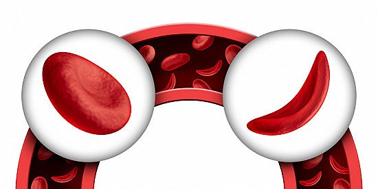 kettychunga's tweet photo. #Sicklecell and the Psychological effects on the #parents nursing the Warriors????
Psycho social support and genetic Counselling services remain a greater need in most if not all African SCD communities.
#scdawareness #zscas #sickleinafrica #NIH https://t.co/f6DJeRas3A