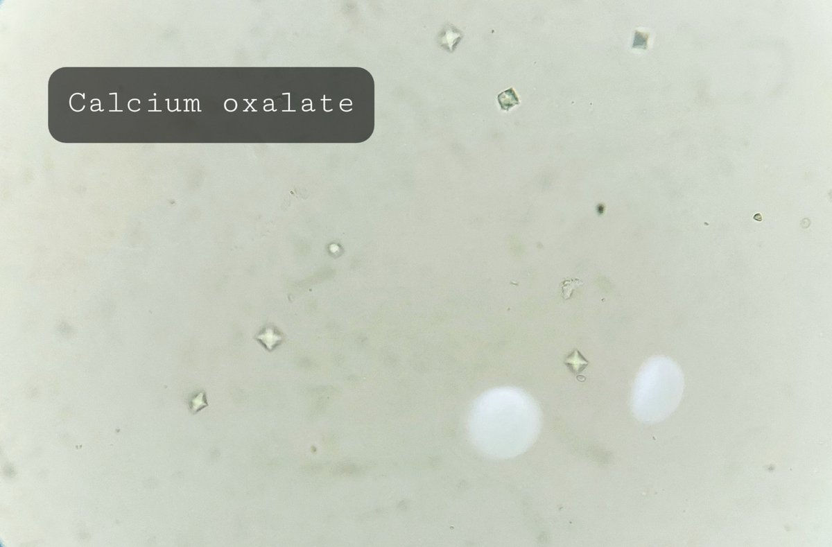 padmapathology1's tweet photo. #crystalsinurine
#clinicalpath #PathTwitter
Last image - reaction of sulphosalycylic acid possibly due to iron https://t.co/lJcpT5eNoQ
