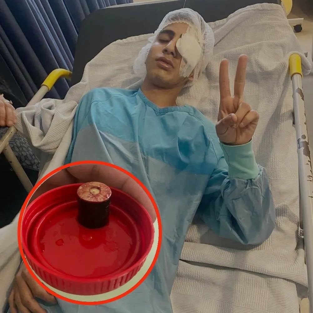 Timesofgaza's tweet photo. Picture of Mohammad Mtour (17 y/old), the Palestinian boy who lost his eye yesterday after being shot with a rubber bullet by the Israeli occupation forces near Al-Ram town, northern Jerusalem. https://t.co/4qbyfTm1Mt