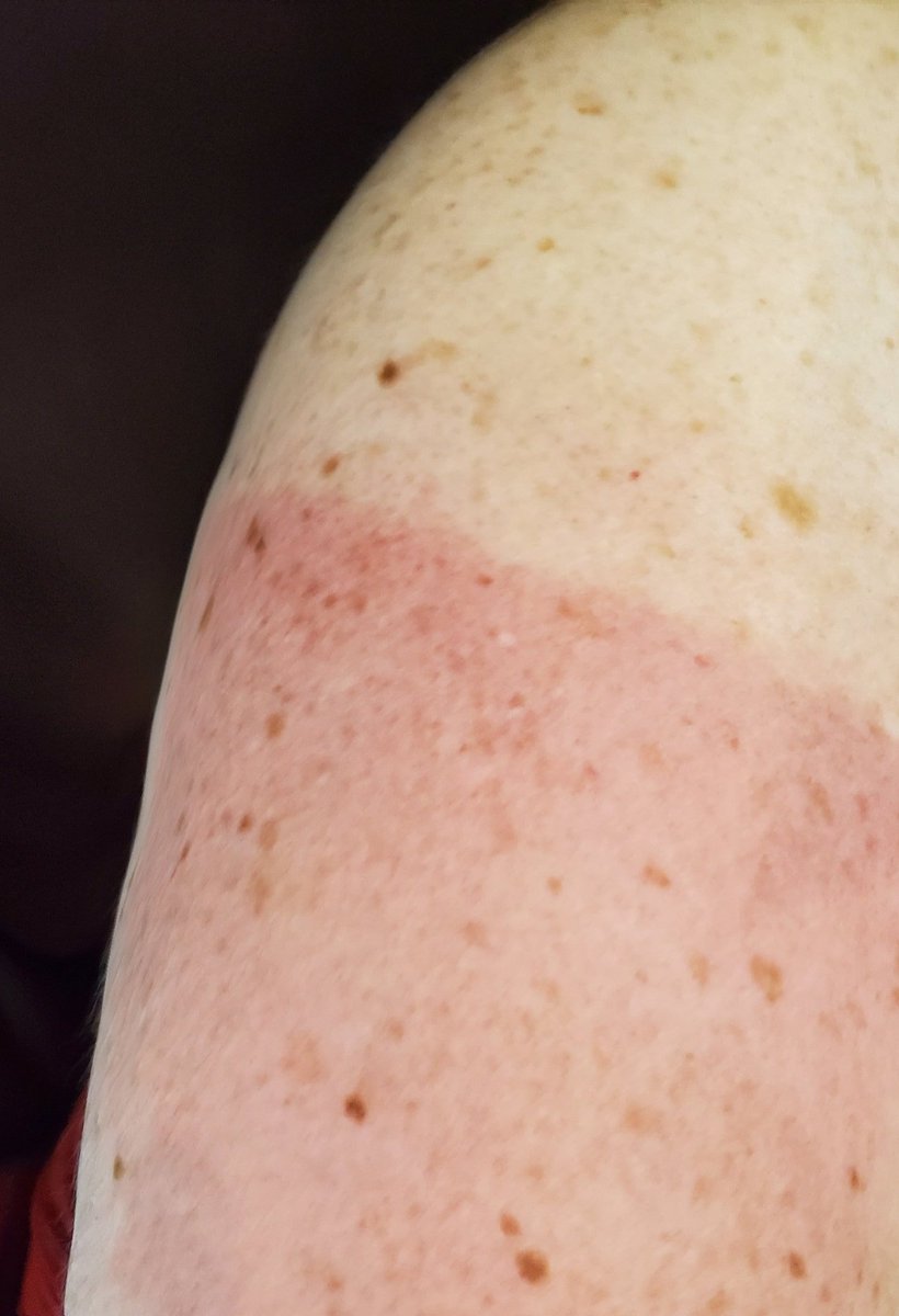 clcarney's tweet photo. With a sunburnt nose and beet red arms, I'm learning a sunny day in Texas is WAY more intense than a sunny day in Missouri. #forgotthesuncreen #sunscreenalways #farmerstan https://t.co/5zWmZL2h82
